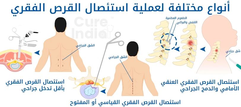 أنواع جراحة استئصال القرص